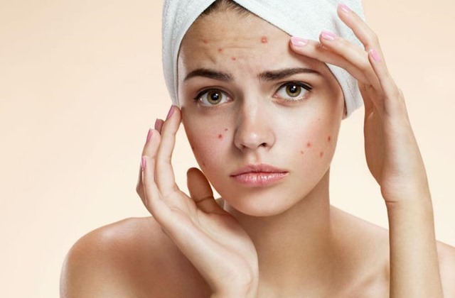 10 nỗi khổi mà chỉ những cô nàng bị mụn mới hiểu
